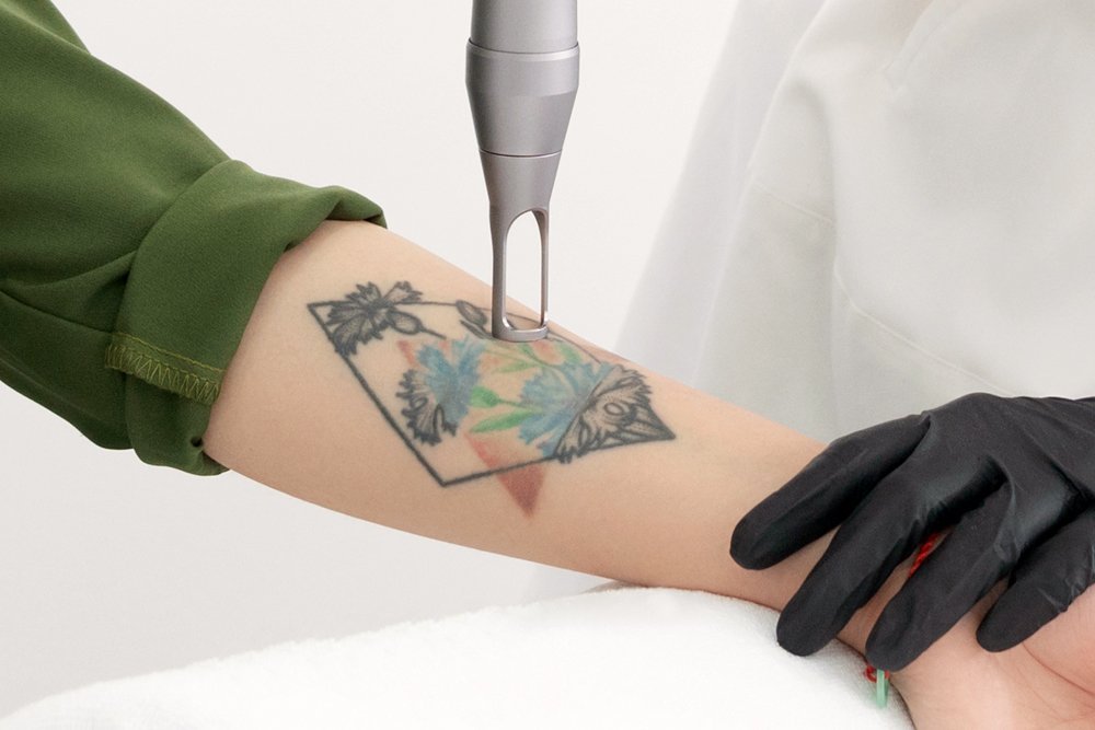 Tattoo Removal